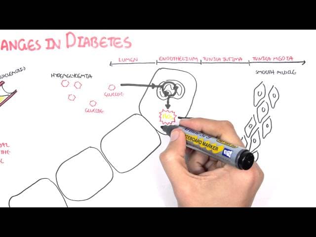 Diabetes Complication and Pathophysiology