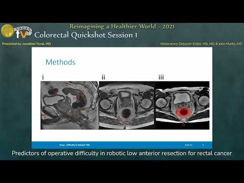 Predictors of operative difficulty in robotic low anterior resection for rectal cancer